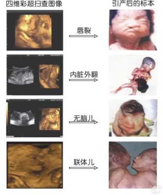 胎儿畸形彩超(四维彩超能检查出哪些畸形病呢) 第1张 胎儿畸形彩超(四维彩超能检查出哪些畸形病呢) 第1张