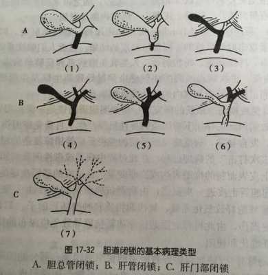 胎儿如何排除胆道闭锁(新生儿胆道闭锁的表现) 第1张 胎儿如何排除胆道闭锁(新生儿胆道闭锁的表现) 第1张