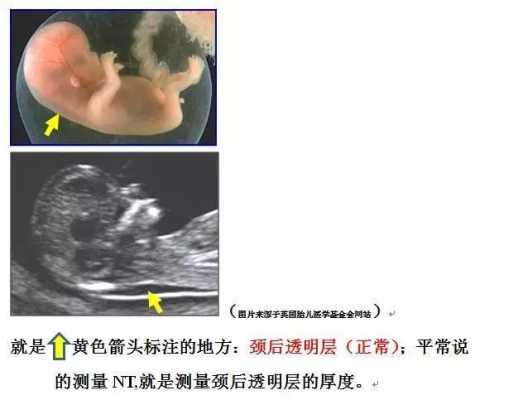 胎儿颈部透明层正常值(我34岁,怀孕12+4,胎儿颈后皮下透明度厚4.5mm请问有什么好的建议) 第1张 胎儿颈部透明层正常值(我34岁,怀孕12+4,胎儿颈后皮下透明度厚4.5mm请问有什么好的建议) 第1张