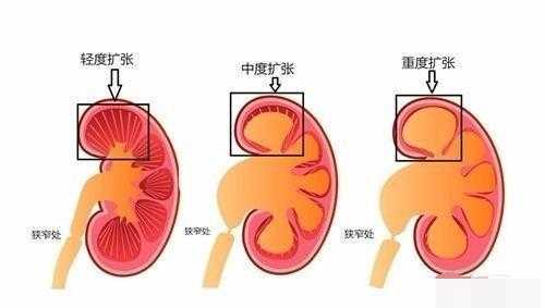 左肾集合系统分离怎么回事,孕晚期胎儿左肾肾盂分离什么意思 第2张 左肾集合系统分离怎么回事,孕晚期胎儿左肾肾盂分离什么意思 第2张