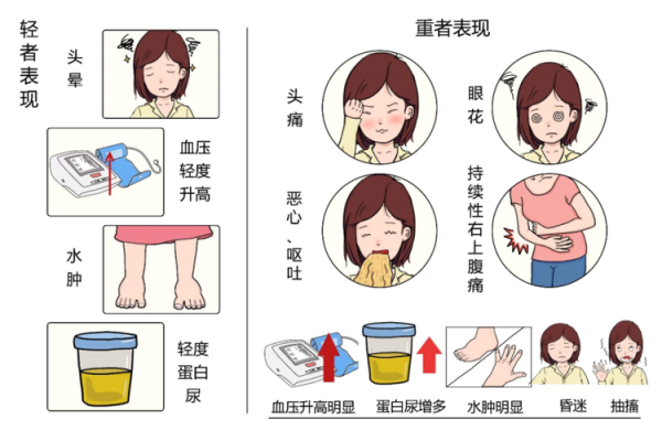 子娴孕期(第一胎重度子痫前期能生二胎吗) 第2张 子娴孕期(第一胎重度子痫前期能生二胎吗) 第2张