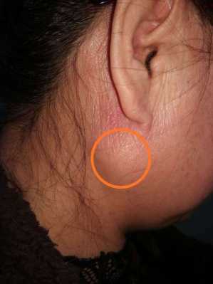 胎儿腮腺(胎儿腮腺囊肿严重吗) 第1张 胎儿腮腺(胎儿腮腺囊肿严重吗) 第1张