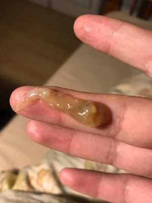 为什么孕中期会出现宫颈粘液栓,孕期易栓症是什么 第1张 为什么孕中期会出现宫颈粘液栓,孕期易栓症是什么 第1张