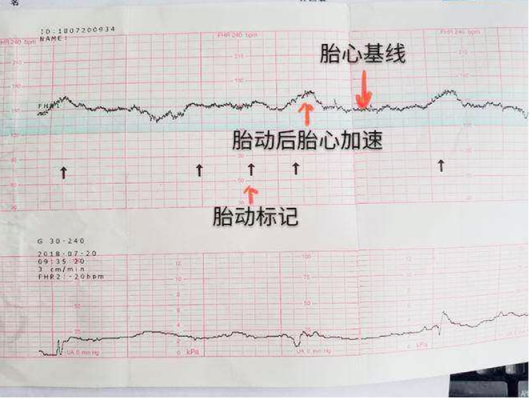 胎儿的心率是多少正常范围,胎儿心博是妊娠第几周 第1张 胎儿的心率是多少正常范围,胎儿心博是妊娠第几周 第1张