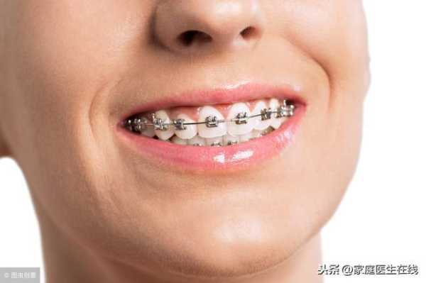 孕期矫正牙齿(孕期矫正牙齿有影响吗) 第1张 孕期矫正牙齿(孕期矫正牙齿有影响吗) 第1张