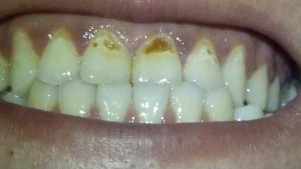 孕期牙齿缺(全瓷牙缺了还能补吗,靠近牙龈处掉了一小块) 第2张 孕期牙齿缺(全瓷牙缺了还能补吗,靠近牙龈处掉了一小块) 第2张