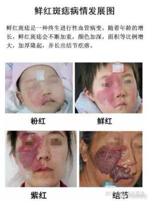 胎儿胎记是什么原因造成,胎儿长胎记是什么原因造成的 第2张 胎儿胎记是什么原因造成,胎儿长胎记是什么原因造成的 第2张