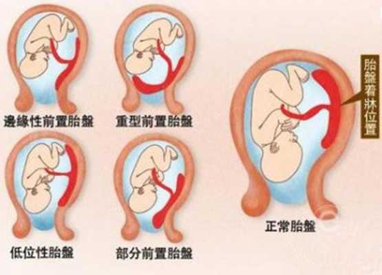 胎盘前壁胎儿图(胎盘前壁胎儿图片欣赏) 第1张 胎盘前壁胎儿图(胎盘前壁胎儿图片欣赏) 第1张