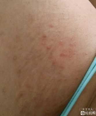 孕期身上红疙瘩（孕妇腿上起红疙瘩还很痒要怎么办）  第2张