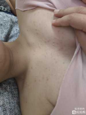 怀孕中期,为什么屁股上长小豆豆,孕期胸长痘痘怎么回事 第1张 怀孕中期,为什么屁股上长小豆豆,孕期胸长痘痘怎么回事 第1张