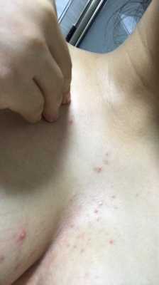 怀孕中期,为什么屁股上长小豆豆,孕期胸长痘痘怎么回事 第2张 怀孕中期,为什么屁股上长小豆豆,孕期胸长痘痘怎么回事 第2张
