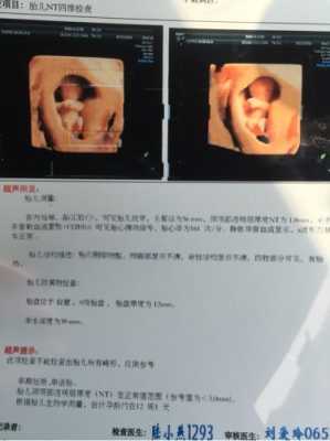 12周胎儿nt(12周胎儿nt值正常范围) 第3张 12周胎儿nt(12周胎儿nt值正常范围) 第3张