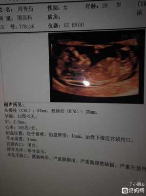 12周胎儿nt(12周胎儿nt值正常范围) 第2张 12周胎儿nt(12周胎儿nt值正常范围) 第2张