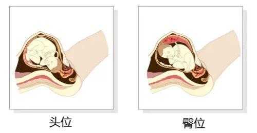 胎儿头位和臀位的区别(什么是臀位d) 第1张 胎儿头位和臀位的区别(什么是臀位d) 第1张