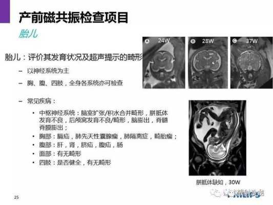 核磁共振对胎儿有影响吗(胎儿做核磁共振对胎儿有影响吗) 第2张 核磁共振对胎儿有影响吗(胎儿做核磁共振对胎儿有影响吗) 第2张