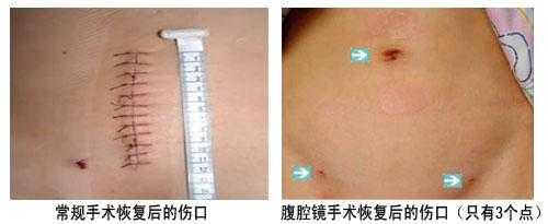 孕期囊肿手术(孕期囊肿手术是微创还是开腹) 第2张 孕期囊肿手术(孕期囊肿手术是微创还是开腹) 第2张