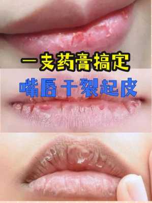 孕妇嘴唇干裂脱皮怎么办,孕妇唇干裂怎么办 第1张 孕妇嘴唇干裂脱皮怎么办,孕妇唇干裂怎么办 第1张