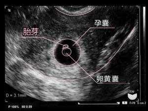 胎芽回声是什么意思,胎儿和胎芽的区别 第1张 胎芽回声是什么意思,胎儿和胎芽的区别 第1张