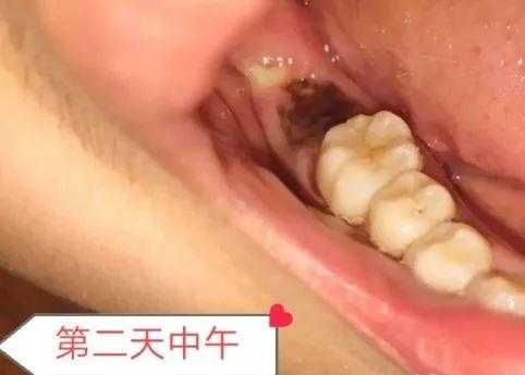 孕6周+,智齿发炎疼,孕期可以拔牙吗,孕期可以拔牙吗 第1张 孕6周+,智齿发炎疼,孕期可以拔牙吗,孕期可以拔牙吗 第1张