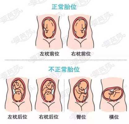 胎儿右枕后位图片(胎儿右枕后位图片) 第1张 胎儿右枕后位图片(胎儿右枕后位图片) 第1张