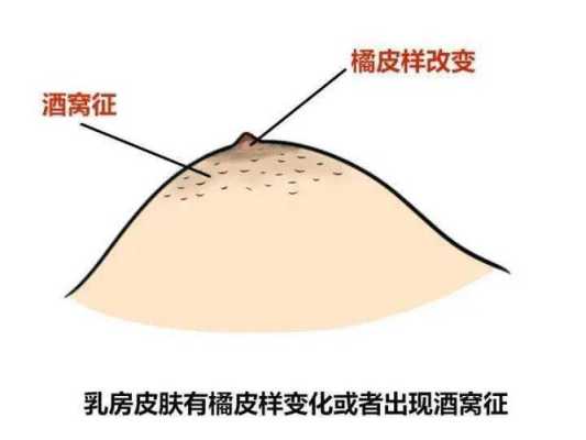 孕期乳房分泌乳(孕期乳房分泌乳液正常吗) 第2张 孕期乳房分泌乳(孕期乳房分泌乳液正常吗) 第2张