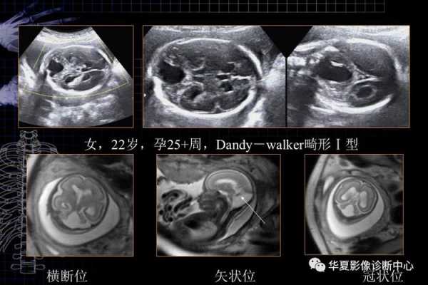 胎儿脑磁共振(胎儿脑磁共振检查对小孩有影响吗) 第1张 胎儿脑磁共振(胎儿脑磁共振检查对小孩有影响吗) 第1张