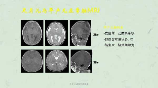 胎儿脑磁共振(胎儿脑磁共振检查对小孩有影响吗) 第2张 胎儿脑磁共振(胎儿脑磁共振检查对小孩有影响吗) 第2张