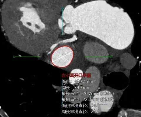 请问胎儿B超中HC,AC,HL是什么意思,Hl代表胎儿什么意思啊 第1张 请问胎儿B超中HC,AC,HL是什么意思,Hl代表胎儿什么意思啊 第1张