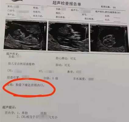 胎儿下缘达宫颈内口(胎盘下缘达宫颈内口边缘这正常吗) 第2张 胎儿下缘达宫颈内口(胎盘下缘达宫颈内口边缘这正常吗) 第2张