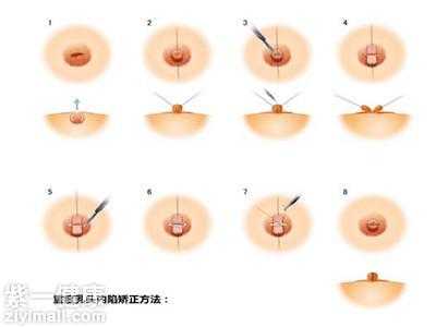 孕期乳头内陷怎么办？这是什么情况啊,孕期乳头矫正器矫正凹陷乳头流水是怎么回事 怎么办  第2张