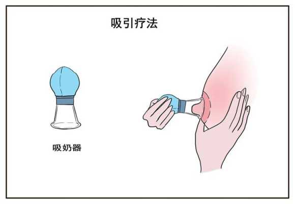 孕期乳头内陷怎么办？这是什么情况啊,孕期乳头矫正器矫正凹陷乳头流水是怎么回事 怎么办  第1张