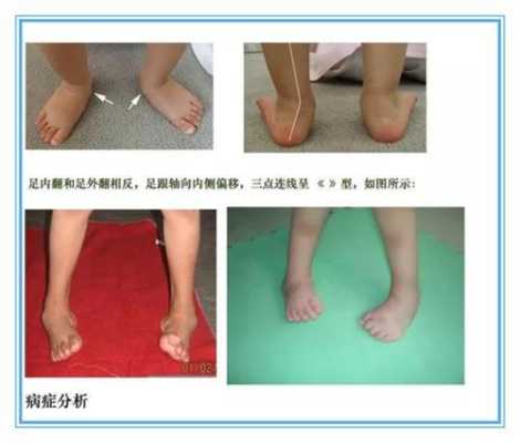 什么是胎儿足内翻,胎儿脚内翻是怎么回事 第1张 什么是胎儿足内翻,胎儿脚内翻是怎么回事 第1张