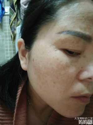 怀孕后期脸上长斑是怎么回事了,孕期长斑图片大全 第2张 怀孕后期脸上长斑是怎么回事了,孕期长斑图片大全 第2张