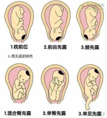 胎儿仰卧位示意图(胎儿仰卧位示意图片) 第2张 胎儿仰卧位示意图(胎儿仰卧位示意图片) 第2张