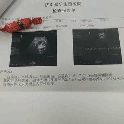 怀孕期间有囊肿(怀孕两个月右附件有个囊肿) 第2张 怀孕期间有囊肿(怀孕两个月右附件有个囊肿) 第2张