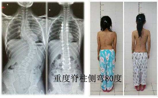 脊柱畸形胎儿（胎儿，脊柱曲度过大怎么办）  第2张