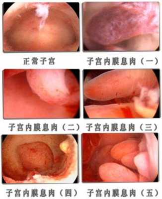 宫颈息肉对胎儿影响(宫颈息肉对胎儿影响大吗) 第1张 宫颈息肉对胎儿影响(宫颈息肉对胎儿影响大吗) 第1张