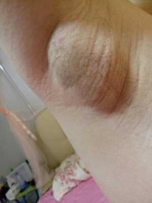 有没有孕期腋下变得很黑，或哪些部位变黑的,孕期腋下疼是怎么回事  第2张