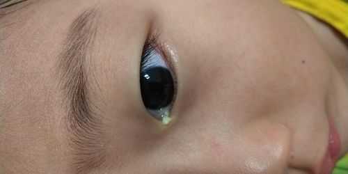 孕期眼屎多(孕期眼屎多怎么回事) 第3张 孕期眼屎多(孕期眼屎多怎么回事) 第3张