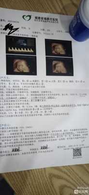 四维彩超心脏有强光点怎么办,24周胎儿左心室强光点怎么办 第2张 四维彩超心脏有强光点怎么办,24周胎儿左心室强光点怎么办 第2张