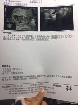 宫腔积液对胎儿的影响（宫腔积液对胎儿的影响过了三个月会减小吗）  第1张
