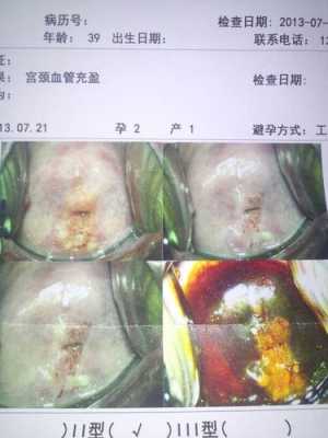 孕期宫颈检查(宫颈切片检查是什么) 第2张 孕期宫颈检查(宫颈切片检查是什么) 第2张