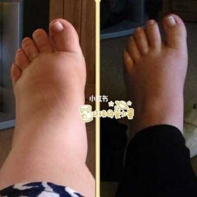 预防孕期水肿(孕妇脚水肿,可以去足底按摩吗) 第1张 预防孕期水肿(孕妇脚水肿,可以去足底按摩吗) 第1张