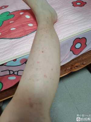 孕期脚面痒（孕期脚面痒越抓越痒咋回事）  第2张