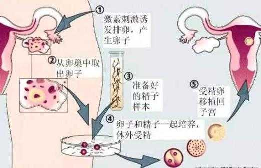 试管婴儿孕期（试管婴儿孕期）  第1张