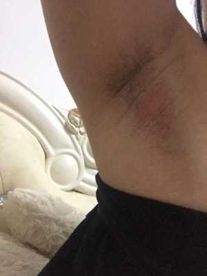 孕期腋下很痒(孕期腋下很痒起了一片红疹) 第2张 孕期腋下很痒(孕期腋下很痒起了一片红疹) 第2张