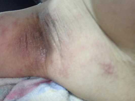 孕期腋下很痒(孕期腋下很痒起了一片红疹) 第1张 孕期腋下很痒(孕期腋下很痒起了一片红疹) 第1张