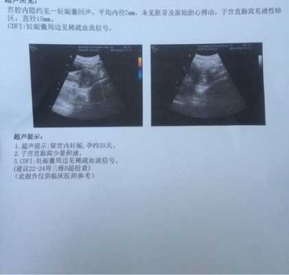 孕期照彩超(孕期照彩超多了好不好) 第1张 孕期照彩超(孕期照彩超多了好不好) 第1张