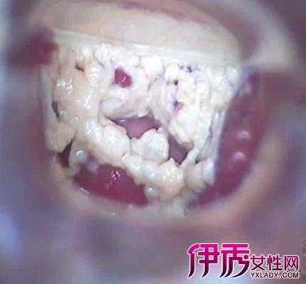 孕妇白带太多怎么办,孕晚期用手抠出一大坨豆腐渣 第2张 孕妇白带太多怎么办,孕晚期用手抠出一大坨豆腐渣 第2张