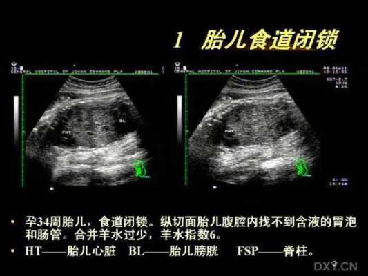 超声对胎儿的影响(超声对胎儿的影响有哪些) 第2张 超声对胎儿的影响(超声对胎儿的影响有哪些) 第2张